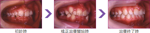 矯正歯科治療の症例